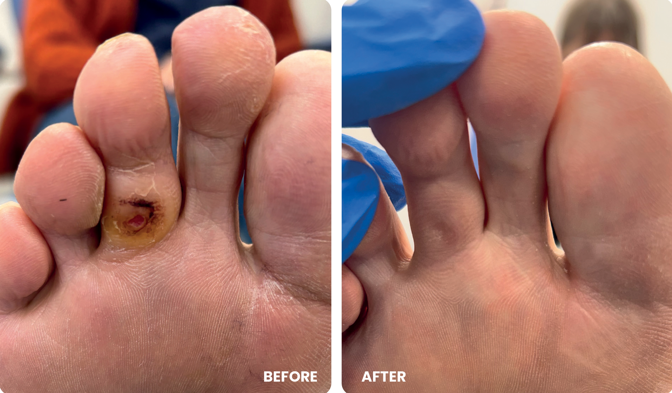 Curacorn treatment example