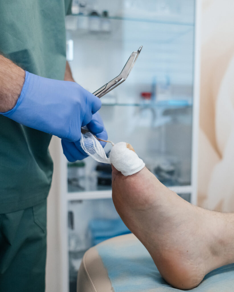 Resection of the nail plate, removal of ingrown nail. Dressing after surgery on the toe. Surgical treatment of onychocryptosis, paronychia and purulent disease