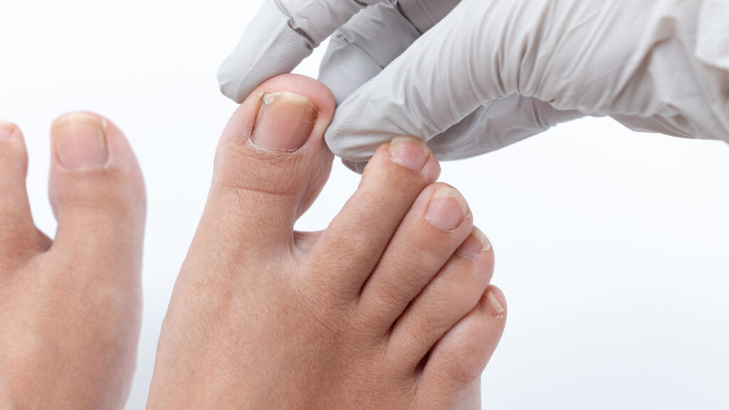 Medical professional examining ingrown toenail on foot, showcasing careful treatment process and attention to patient comfort and hygiene practices